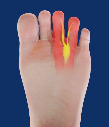 Neuroma Treatments