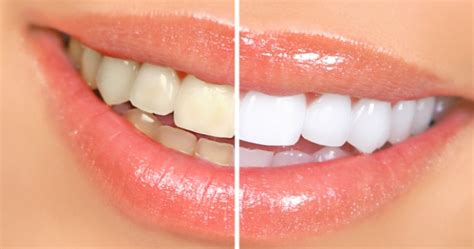 Zoom! Teeth Whitening FAQs | Fidler On The Tooth | 206-526-1437