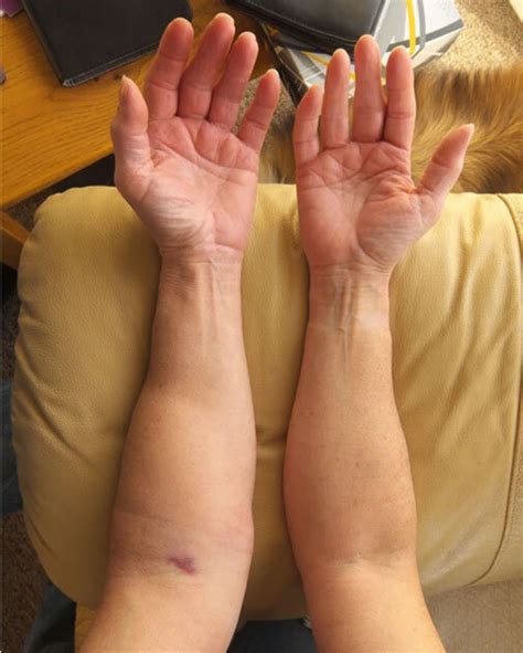 Treatment & Relief of Lymphedema — Horizon Rehabilitation & Sports Medicine