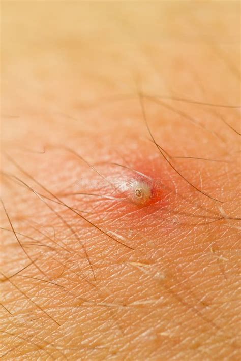 Pimple-Extrem-Makro stockbild. Bild von hautentzündung - 14887981