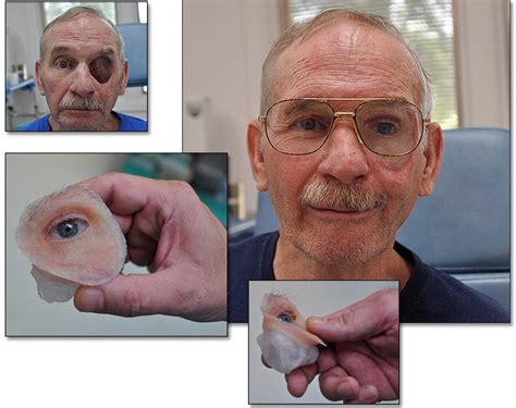 Hemifacial cosmetic prosthesis - RealLifeSkin™ - RealLifeSkin - orbital ...