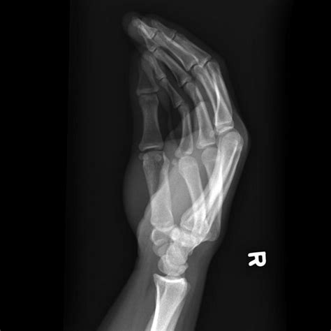 lateral elbow joint effusion 3 - ALiEM