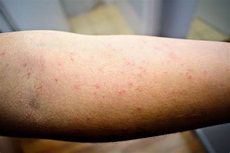 How To Deal With Scabies Or Crusted Scabies Treatment - vrogue.co