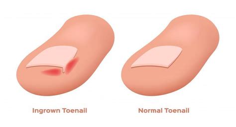 What Causes Ingrown Toenails?: The Foot & Ankle Specialists: Podiatric Medicine
