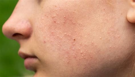 Fungal Acne: Symptoms, Causes, And Treatment - Healthopedia UK