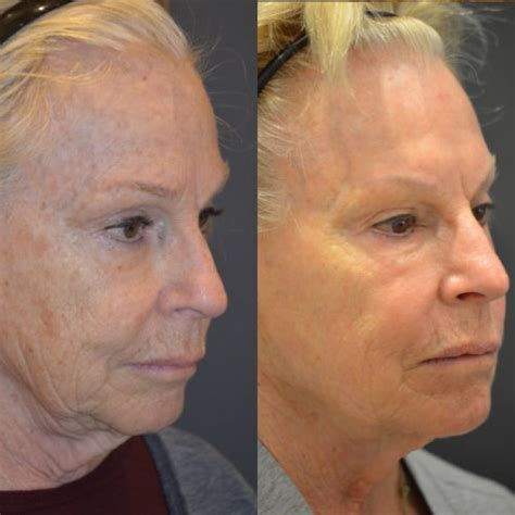 NYC Face Laser Skin Resurfacing | Manhattan Laser Skin Rejuvenation | UES