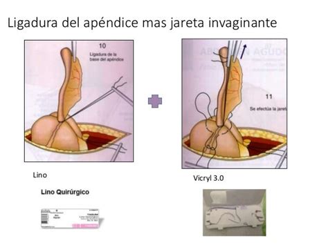 APENDICECTOMIA ABIERTA TECNICA QUIRURGICA PDF