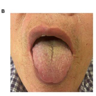 FIGURE The tongue-coating microbial diversities. (A,B) Beta diversity ...