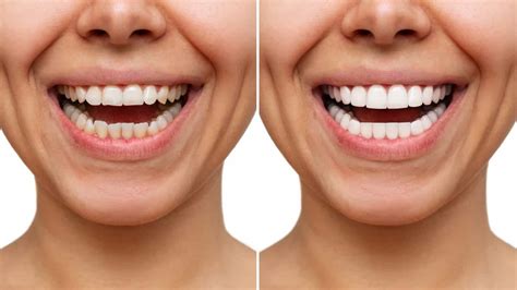 Before and After Teeth Whitening | Professional Whitening | Absolute Dental