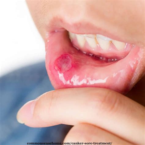 Canker Sore Treatment (How to Get Rid of Canker Sores)