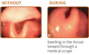 Hereditary Angioedema (HAE) Symptoms