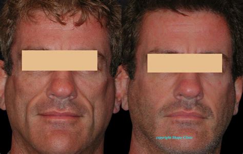 Facial Lipoatrophy Treatment Sydney | Shape Clinic