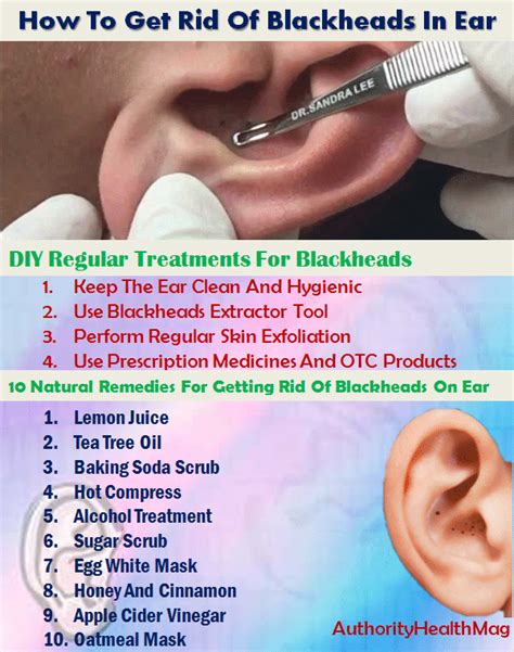 Best Ways To Get Rid Of Blackheads In Ears