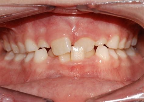 Orthodontic treatment before and after Crossbite - Orthodontix