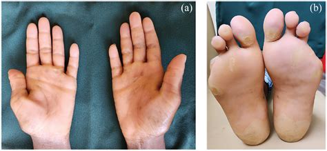 (a) Diffuse palmar keratoderma and (b) diffuse plantar keratoderma. | Download Scientific Diagram