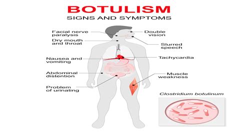 Acidic foods risk botulism and so do North Dakota lawmakers | Food ...