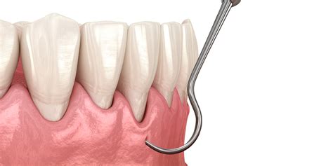 Pinhole Surgical Technique® - Monroe, CT - Gum Recession