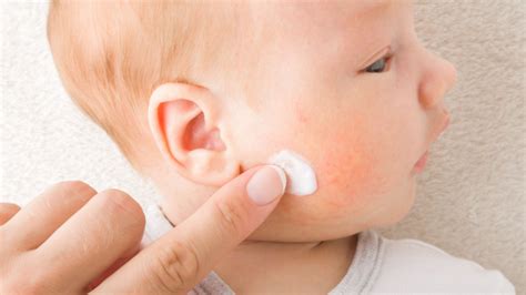 What should you do when your newborn has eczema?