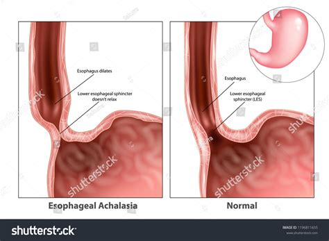 Esophageal Achalasia Often Called Simple Achalasia Stock Vector ...