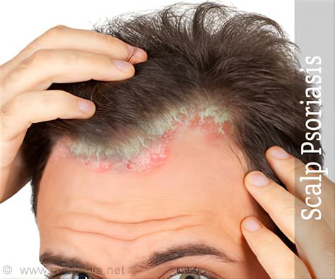 Scalp Psoriasis Dandruff: What's The Difference?, 43% OFF