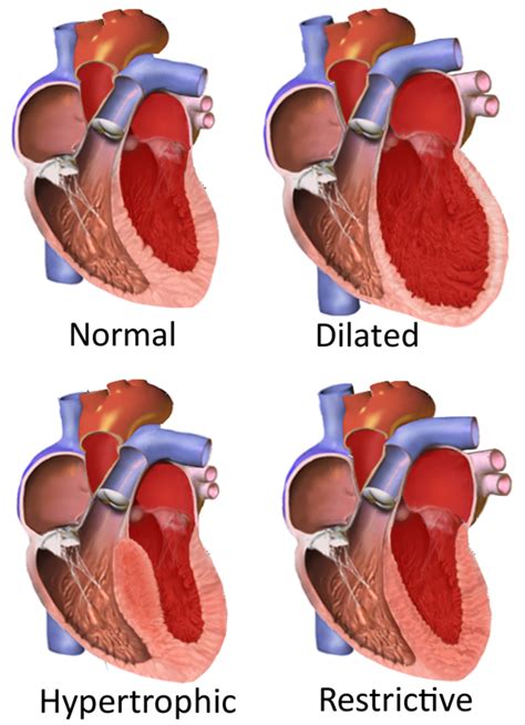 Cardiomyopathy: Types and Treatments - YouMeMindBody