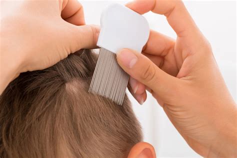 Is it Lice or Dandruff? - Lice Clinics of America - Lexington