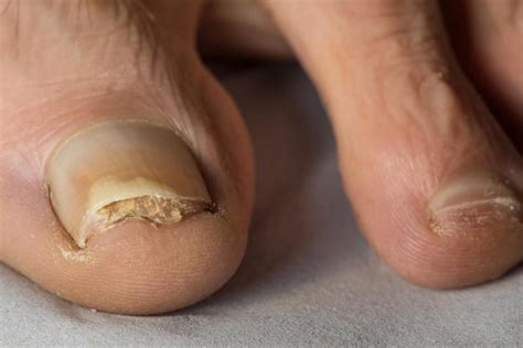 Fungal nail infection | nidirect