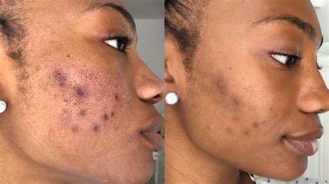 CLEARING UP ACNE SCARRING & HYPERPIGMENTATION! - YouTube
