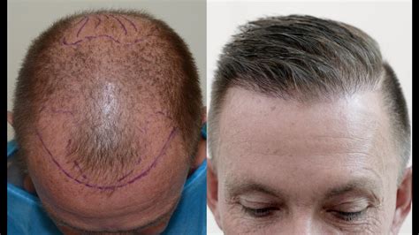 BUSTING MYTHS ABOUT HAIR TRANSPLANT - tastefulspace.com