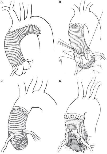 ascending aortic aneurysm | ... Surgical options for aneurysms of the ascending aorta include ...