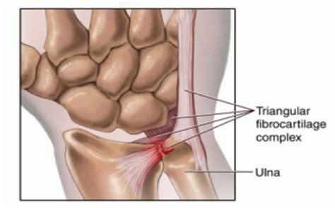 Triangular Fibrocartilage Complex (TFCC) Tear, 41% OFF