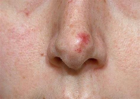 Best safe treatment options for Red Marks, Acne, Rosacea & Thread Veins