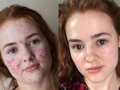 Compra de roaccutane — sin receta en línea