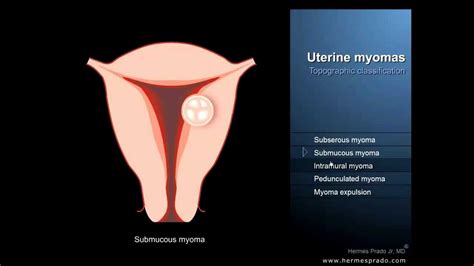 Uterine fibroids or myomas - Definition and symptoms - YouTube