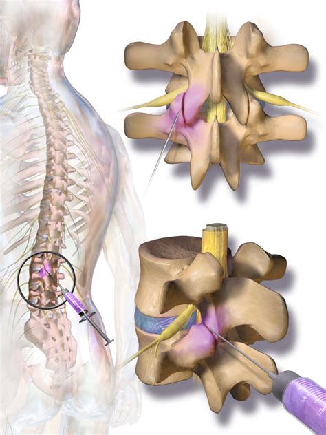 Facet joint injection - Wikipedia