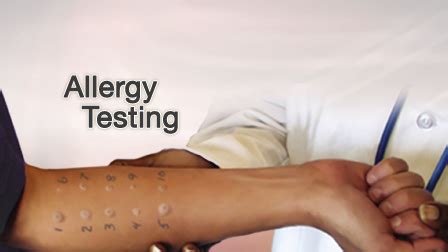 HIE Multimedia - Allergy testing - skin