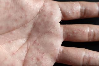 Top 10 eczema on hands and feet 2022