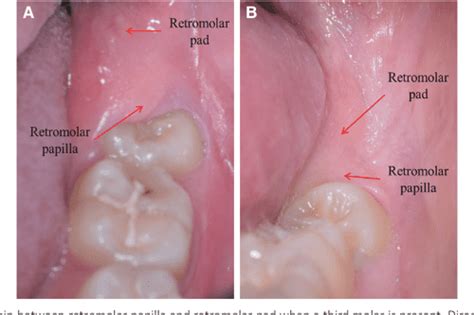 [PDF] Comprehensive understandings in the shape of retromolar pad and ...