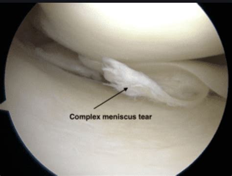 Knee meniscus cartilage tear: Orthopedic Center for Sports Medicine ...