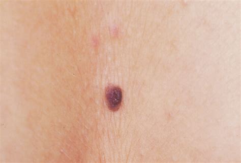 Compound Nevus: Patterns of Compound Nevi —Viquepedia