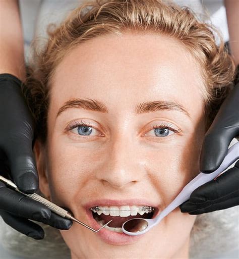 Dental Fillings - Elegant Edge Dentistry