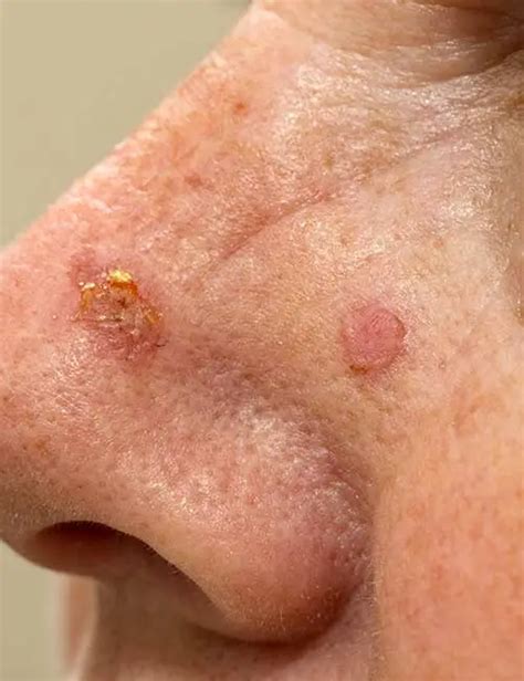 Actinic Keratosis - Dermatologist Chandler AZ 85224, Mohs Surgery 85225, 85226