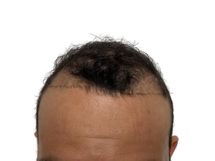 Patient #2218 Hair Transplants Before and After Photos Austin - Plastic Surgery Gallery San ...