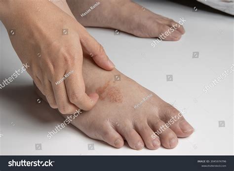 Hand Scratching Foot Infected By Ringworm Stock Photo 2045974796 ...