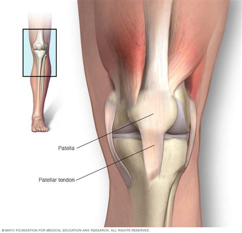 Tendinitis rotuliana - Síntomas y causas - Mayo Clinic