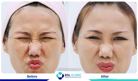 Facial Design and Anti-Aging Treatments - Bangkok Aesthetic Clinic