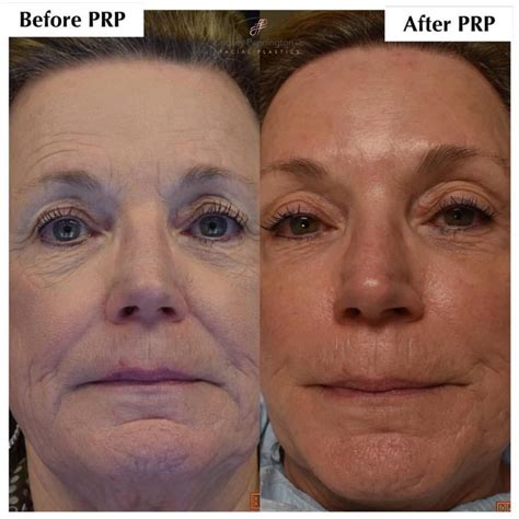 Microneedling with PRP Before And After Gallery - Pennington