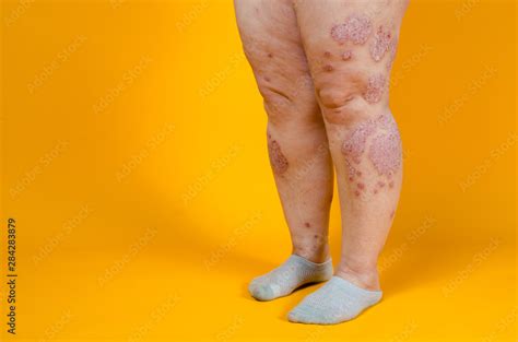 Dermatological skin disease. psoriasis, eczema, dermatitis, allergies. Skin lesions on the legs ...