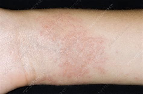 √1000以上 eczema rash on wrist 329558-Contact dermatitis rash on wrist
