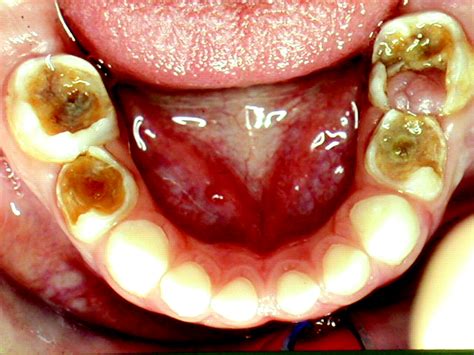 Oral Cavity Teeth